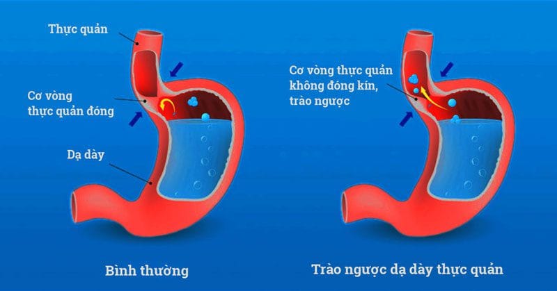 trao-nguoc-da-day-thuc-quan